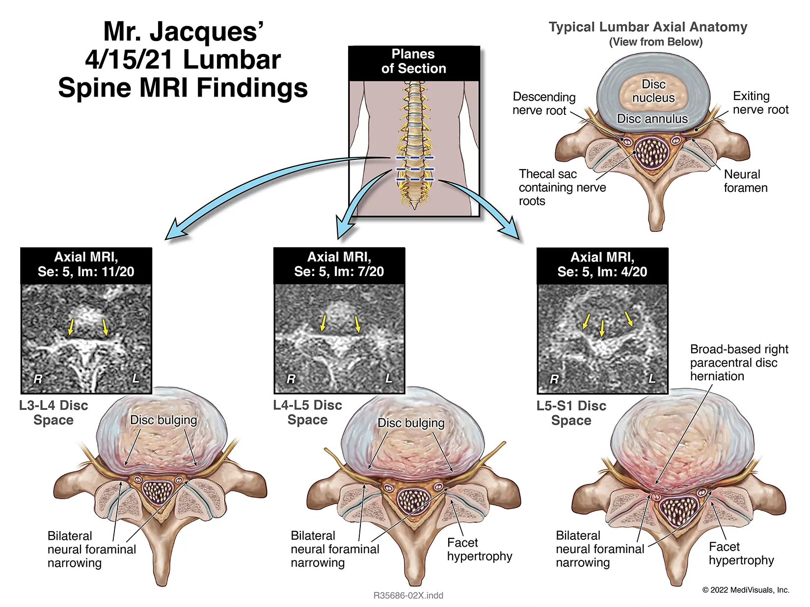 4-15-21 Lumbar Spine Axial view MRI MEDIVISUAL (Jacques)