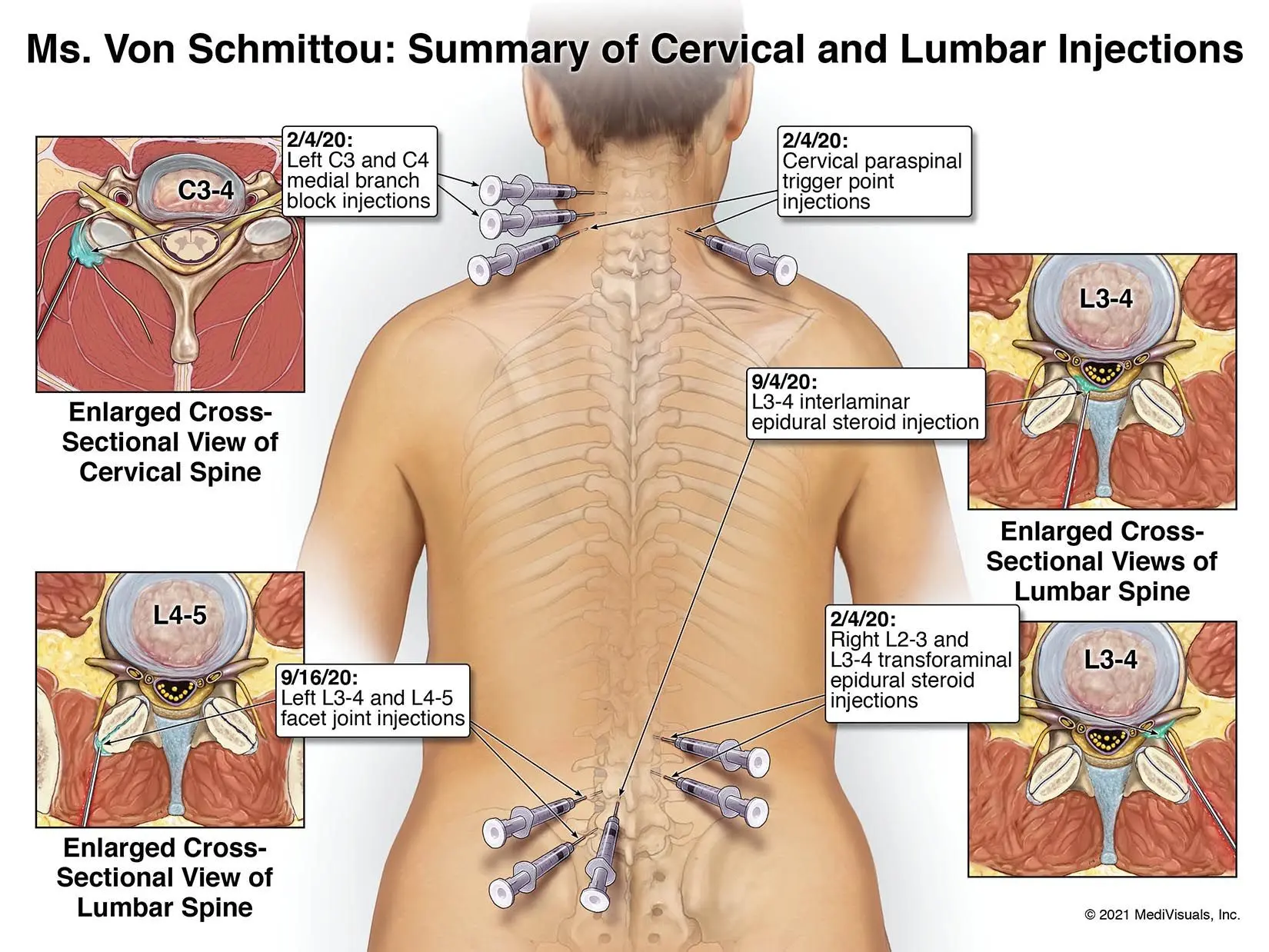 Cervical Lumbar Injections